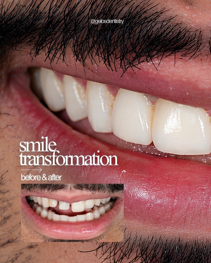Smile transformation before and after result at Gelos Dentistry, Zirakpur