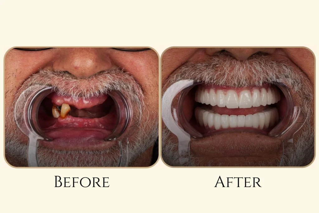 Gelos Dentistry Implant surgery