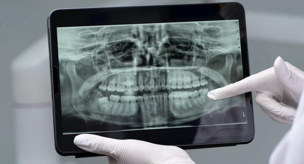 Creating the Surgical Guide at Gelos Dentistry