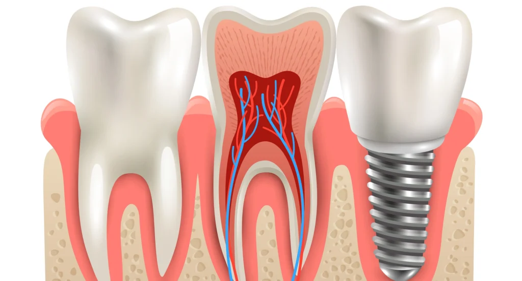 Dental Implants at Gelos Dentistry