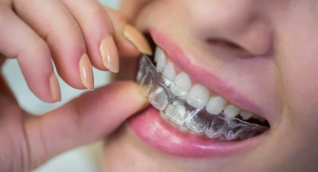 Clear Aligners & Invisalign at Gelos Dentistry