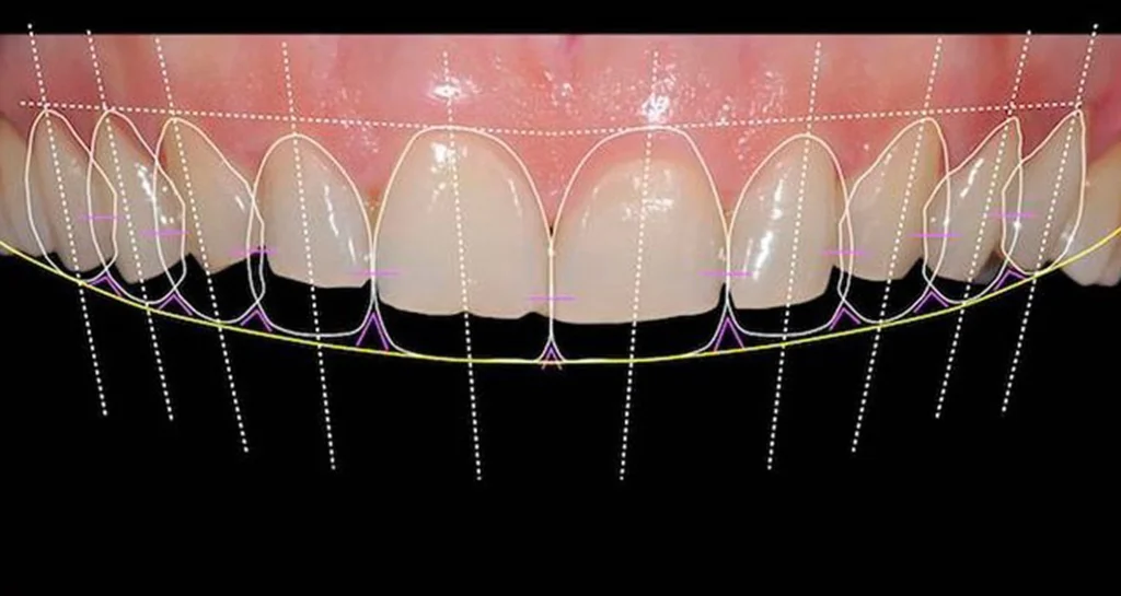 Digital Smile Design at Gelos Dentistry