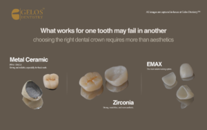 What Works for One Tooth May Fail in Another: Choosing the Right Dental Crown Requires More Than Aesthetics