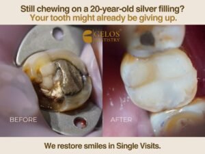 How Long Do Dental Fillings Last? When to Replace Them