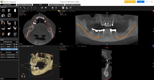 CBCT scan slice showing mandibular nerve tracing for precise dental implant and surgical treatment planning.