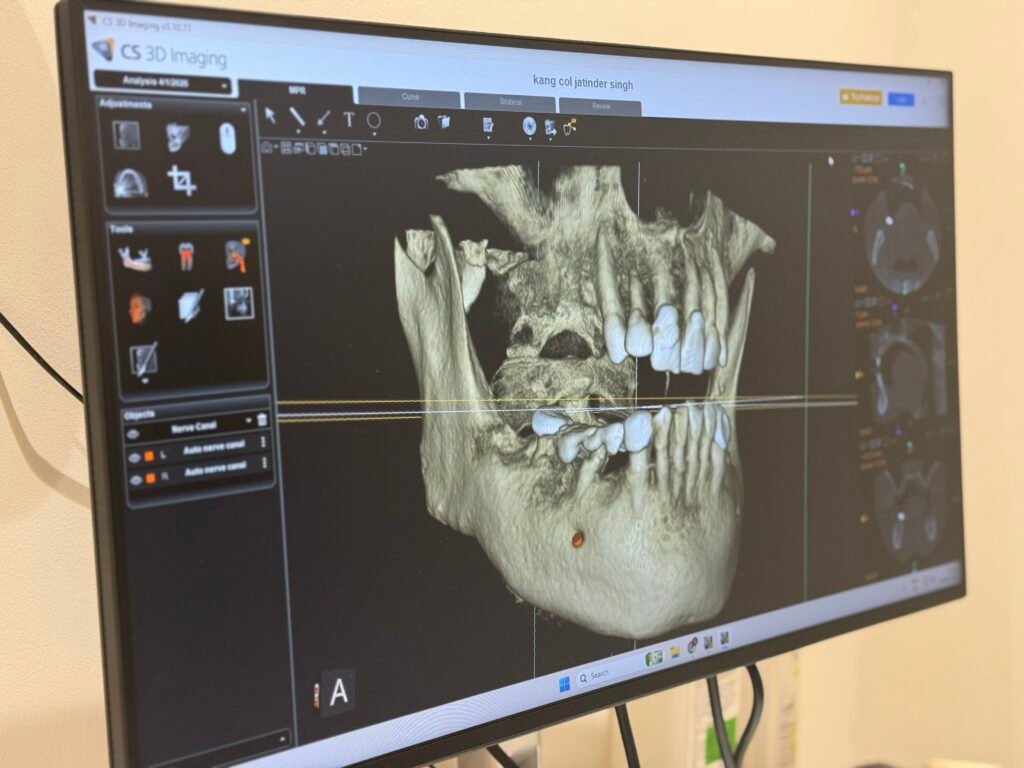 CBCT scan showing multiple missing teeth during dental implant treatment planning at Gelos Dentistry in Mohali.