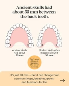Illustration of a human skull showing crowded teeth and changes in facial development associated with reduced jaw space.