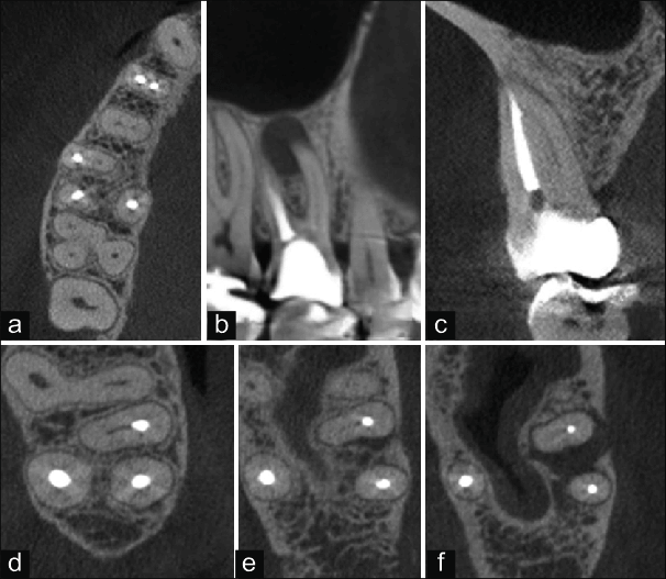 CBCT slice showing root canal anatomy and a missed canal in a tooth during endodontic evaluation.