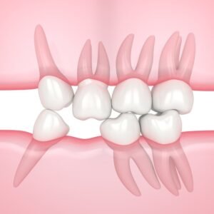 Missing tooth causing neighboring teeth to shift and creating gaps that may require a dental bridge or tooth replacement in Zirakpur