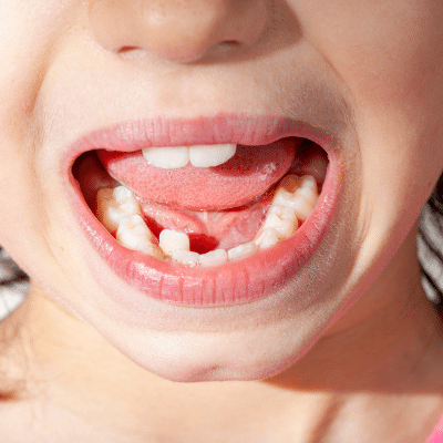 Child with crowded lower front teeth and erupting permanent teeth, demonstrating insufficient jaw space and developing dental crowding.