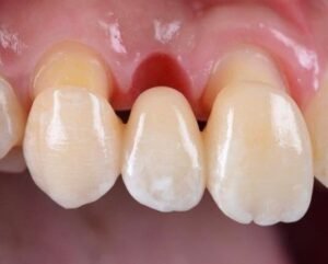 Dental bridge replacing a missing front tooth and restoring smile aesthetics at Gelos Dentistry in Zirakpur
