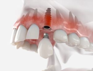 Illustration of a dental implant with its three parts: implant post, abutment, and crown embedded in the jawbone.