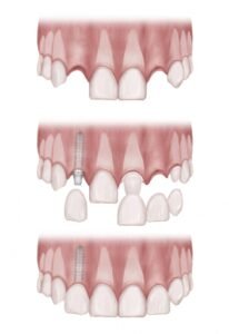 Dental Implants vs Bridges: Which Is Better for Replacing Missing Teeth?