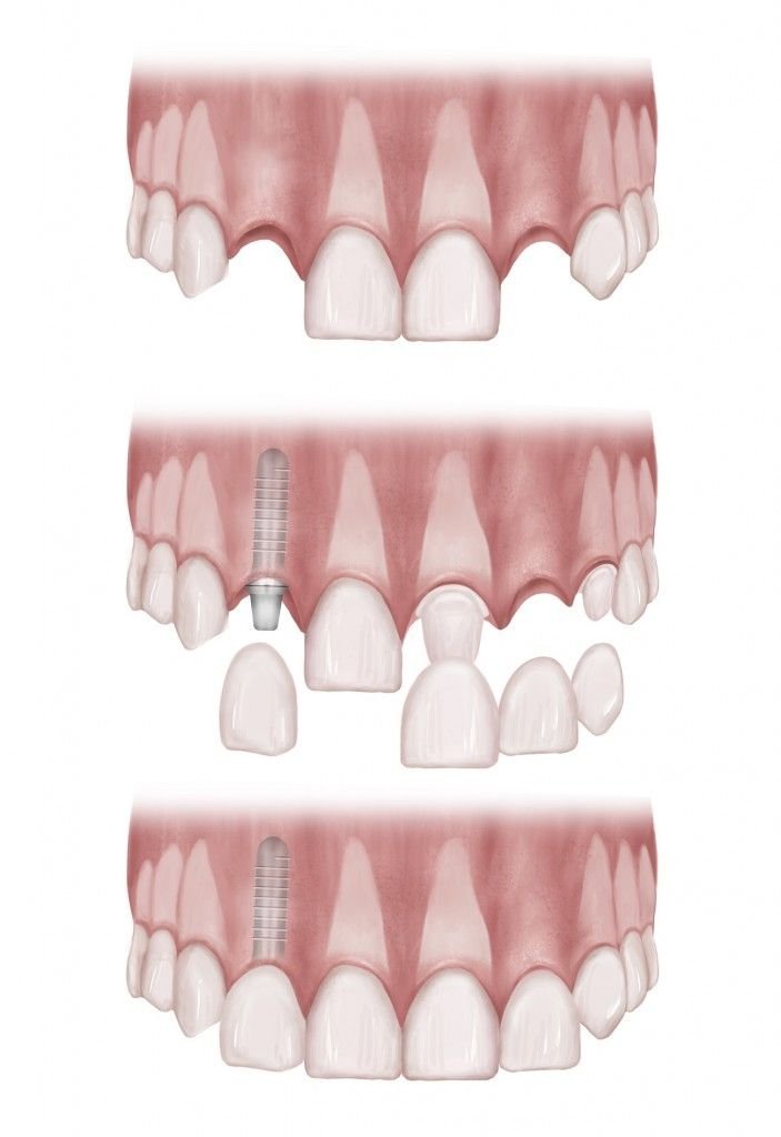 Illustration comparing a missing front tooth restored with a dental implant, showing the implant fixture, abutment, and crown replacing the missing tooth without affecting adjacent teeth.