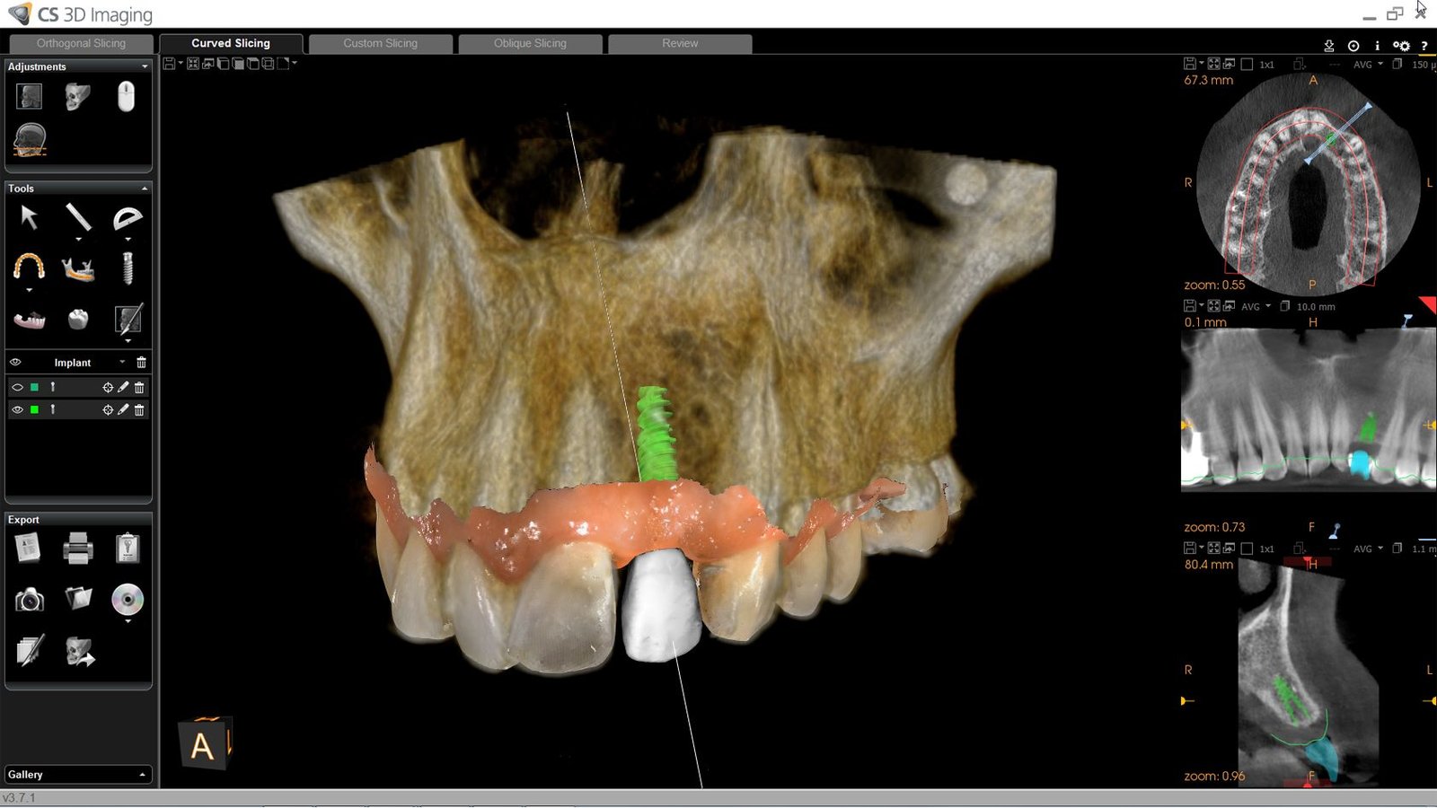 Digitally planned dental implant displayed on a CBCT scan for precise implant placement and treatment planning.