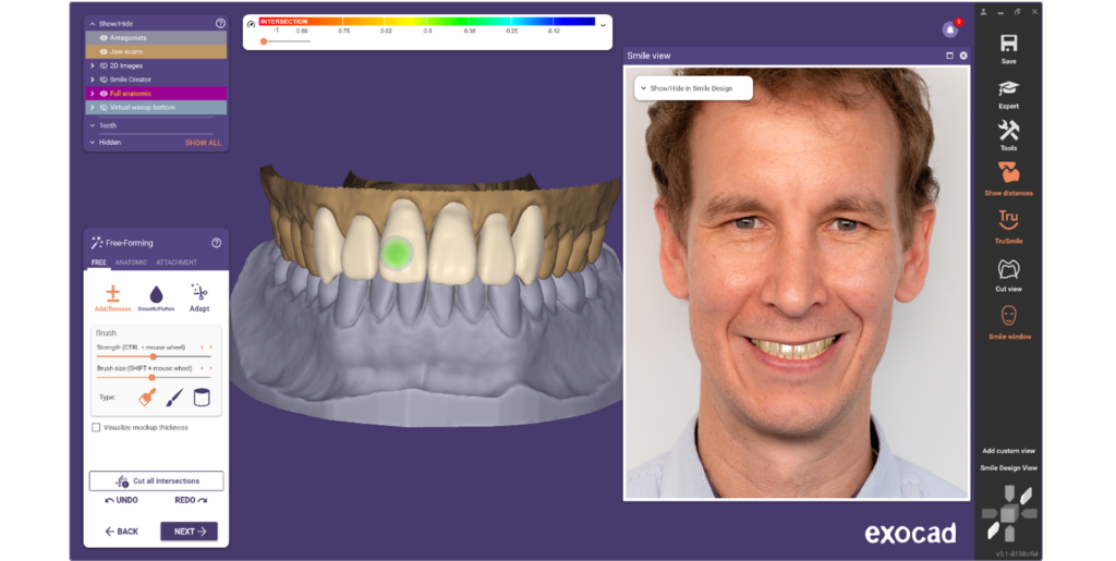 Digital Smile Design facial analysis used to plan a personalized smile makeover and cosmetic dental treatment.