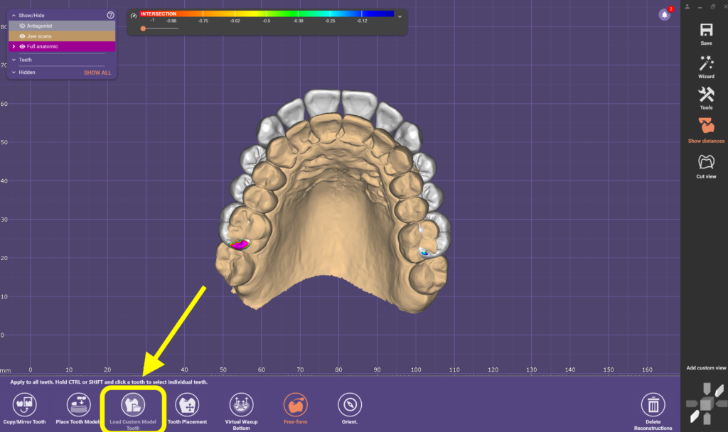 Digital veneer design created using CAD/CAM dental software for precise smile makeover planning.