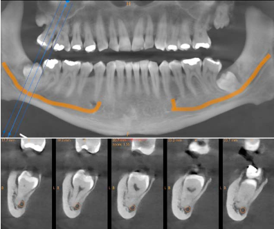 CBCT scan showing an impacted wisdom tooth and its position within the jaw before surgical extraction.