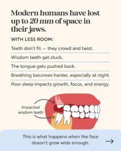 Illustration comparing historical and modern jaw dimensions, showing reduced space available for tooth eruption and dental arch development.