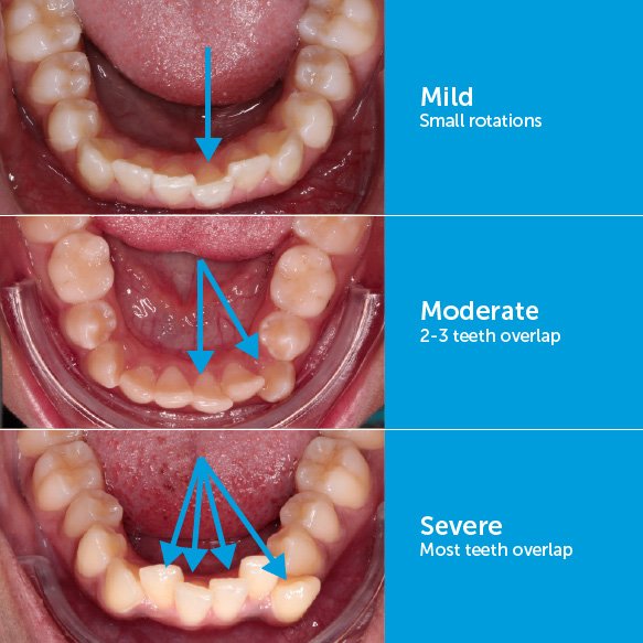 Clinical photographs showing mild, moderate, and severe lower front teeth crowding in a child, illustrating different degrees of dental arch space deficiency.