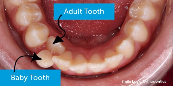 Lower dental arch showing a permanent tooth erupting behind a retained baby tooth, illustrating early dental crowding and mixed dentition in a child.