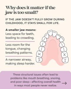 Illustration showing how a smaller jaw can lead to crowded teeth, reduced tongue space, and a narrower airway affecting breathing and sleep.