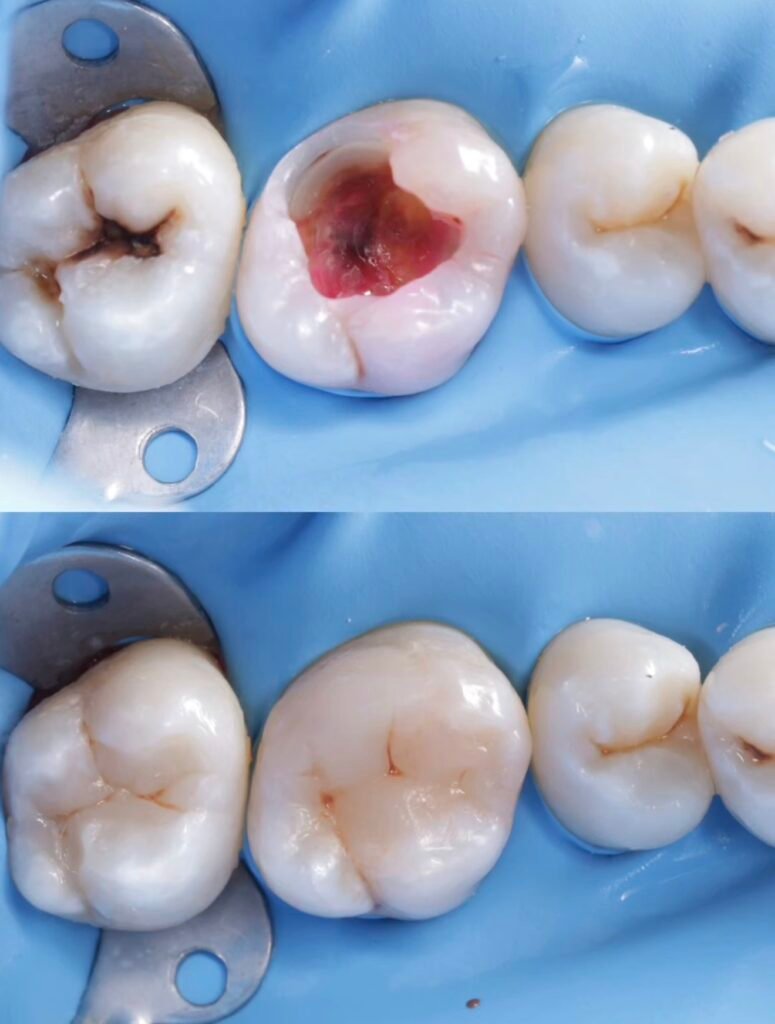 Before and after image showing a deep cavity restored with a tooth-colored composite filling under rubber dam isolation at Gelos Dentistry Zirakpur.