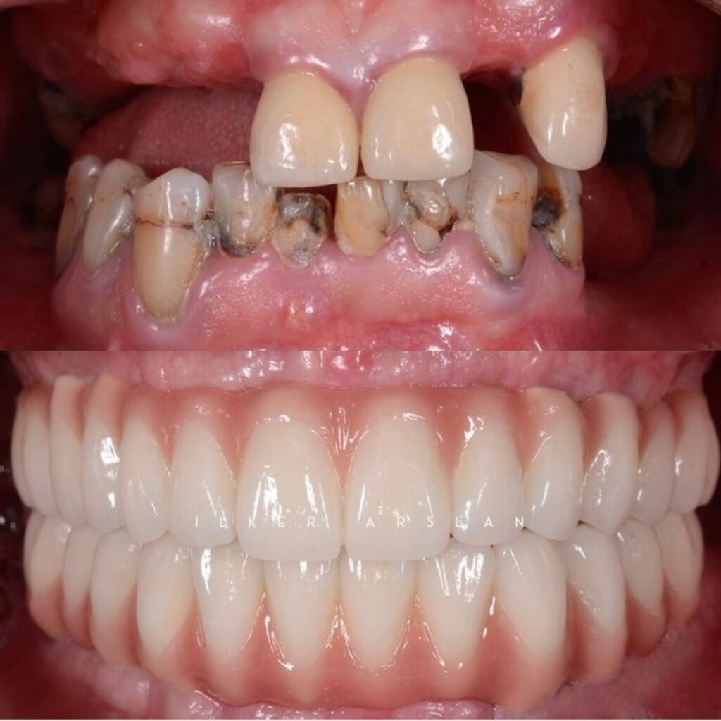 Before and after full mouth dental implant rehabilitation replacing multiple missing and damaged teeth at Gelos Dentistry in Zirakpur