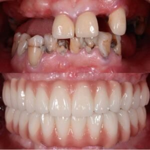 Semi-Fixed Dentures: A Complete Patient Guide to Implant-Retained Dentures