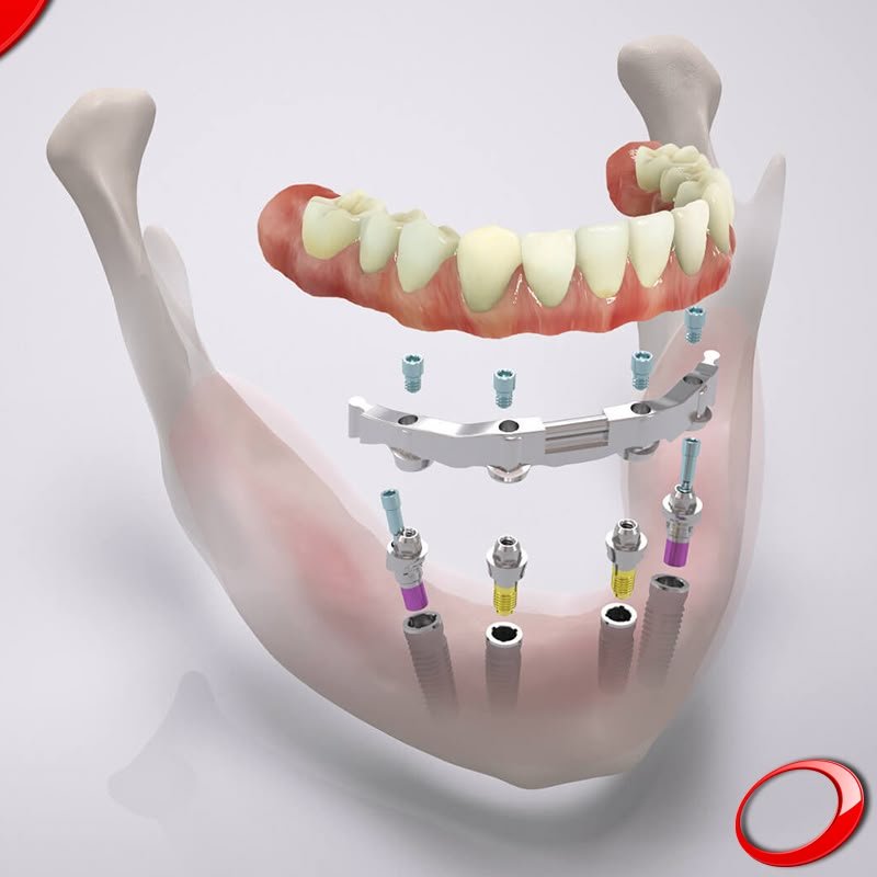 Fixed full-arch implant prosthesis supported by multiple dental implants with a screw-retained titanium framework