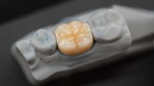 Composite restoration positioned on a dental model showing detailed occlusal anatomy and morphology
