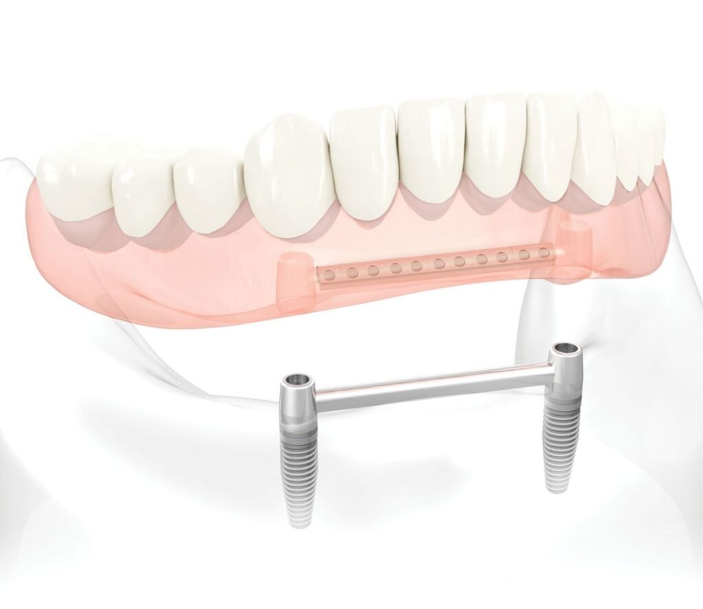 Bar-retained implant overdenture supported by two dental implants for improved denture stability and retention
