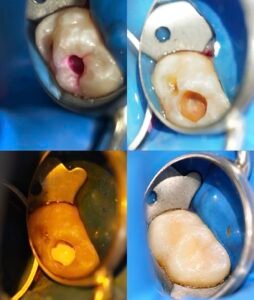 Clinical sequence showing a tooth-colored composite restoration under rubber dam isolation, including cavity preparation, adhesive bonding, composite build-up, and final restoration at Gelos Dentistry Zirakpur.