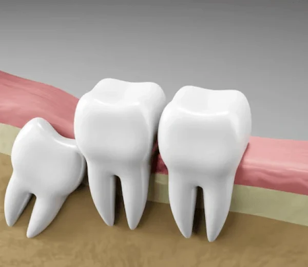 Wisdom Tooth Extraction at Gelos Dentistry