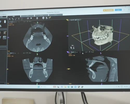 Digital Smile Design with 5D Intraoral Scanner at Gelos Dentistry