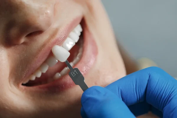 E‑max Crowns at Gelos Dentistry