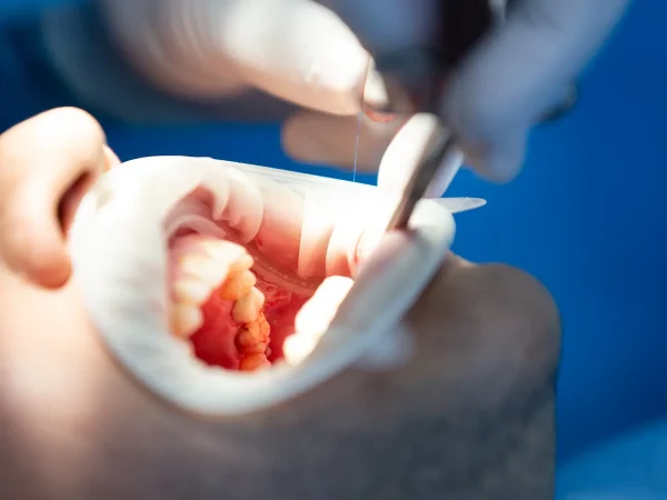 Fitting and Cementation at Gelos Dentistry