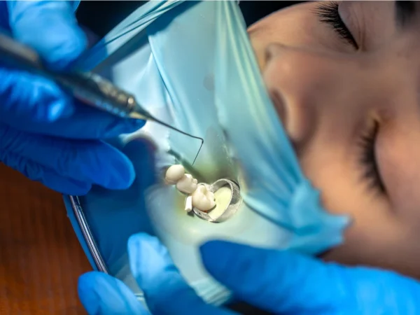 Fillings for Milk Teeth​ at Gelos Dentistry