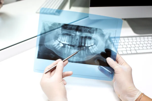 Digital Smile Design with 5D Intraoral Scanner at Gelos Dentistry