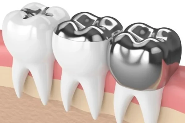Porcelain‑Fused‑to‑Metal (PFM) Crowns at Gelos Dentistry