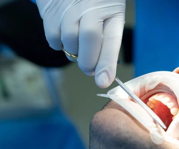 Root Canal at Gelos Dentistry