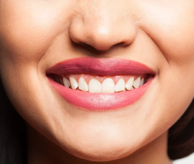 Smile Designing at Gelos Dentistry